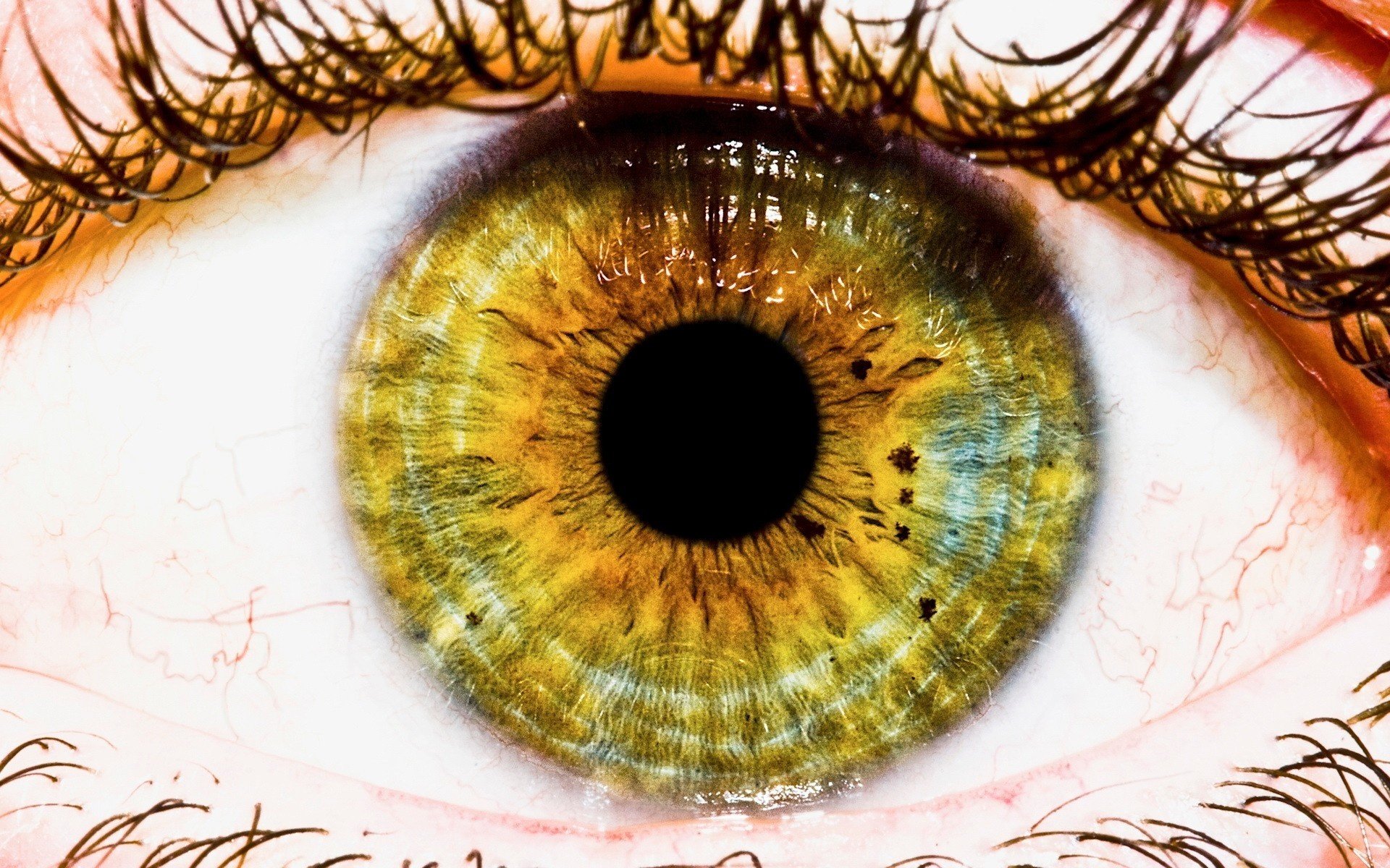 The cornea is gray in the girl's eye